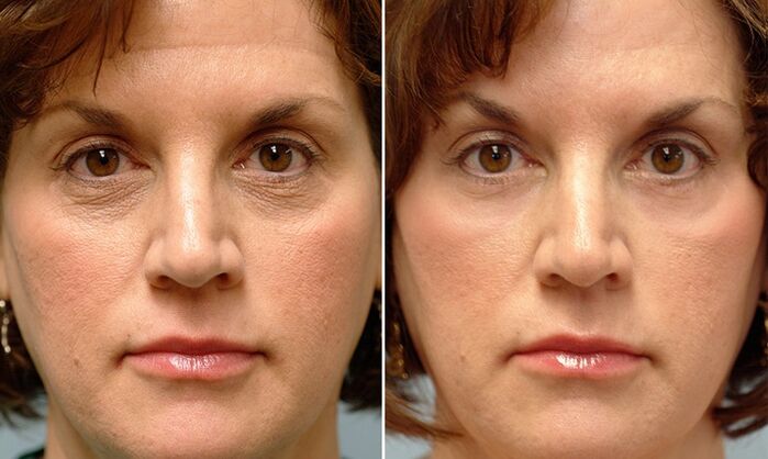 lazer fraksiyonel gençleştirme öncesi ve sonrası yüz