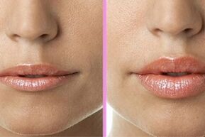 dudak restorasyon işleminden önce ve sonra